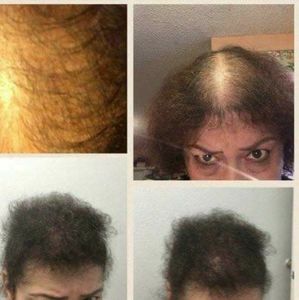 hair growth treatment